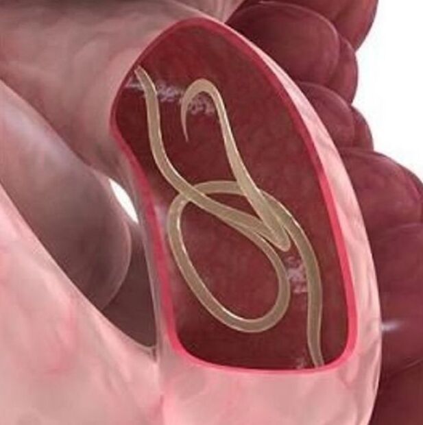 Gastrointestinal sistemdeki bir kişide solucan belirtileri